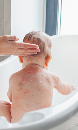 Bambino con dermatite atopica